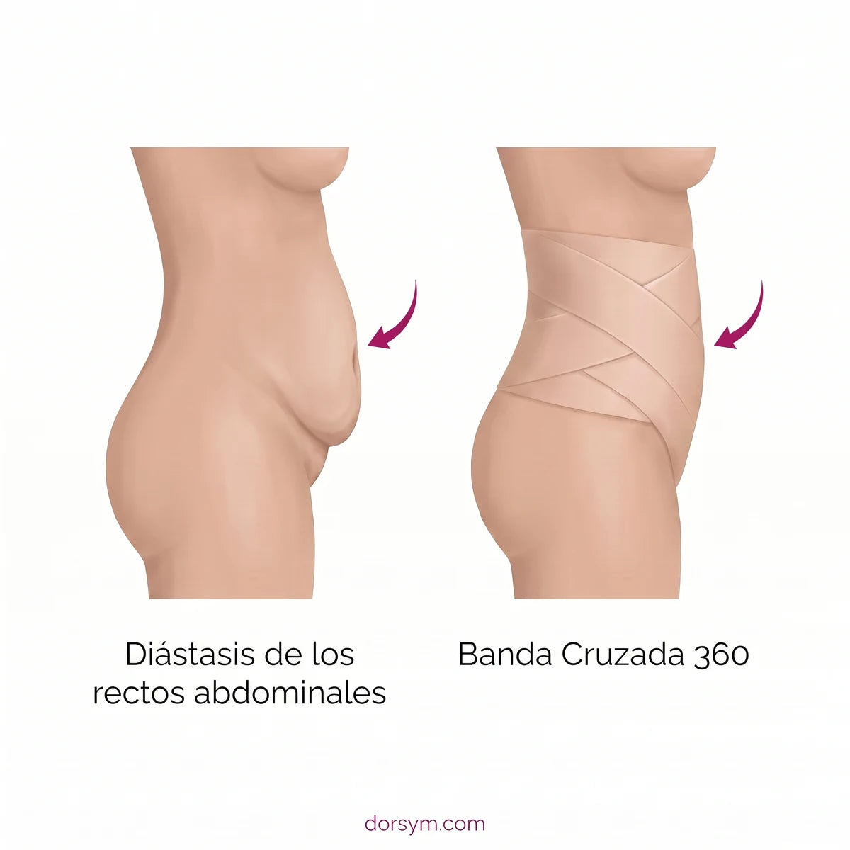 Diástasis de los rectos abdominales vs. Banda Cruzada 360°